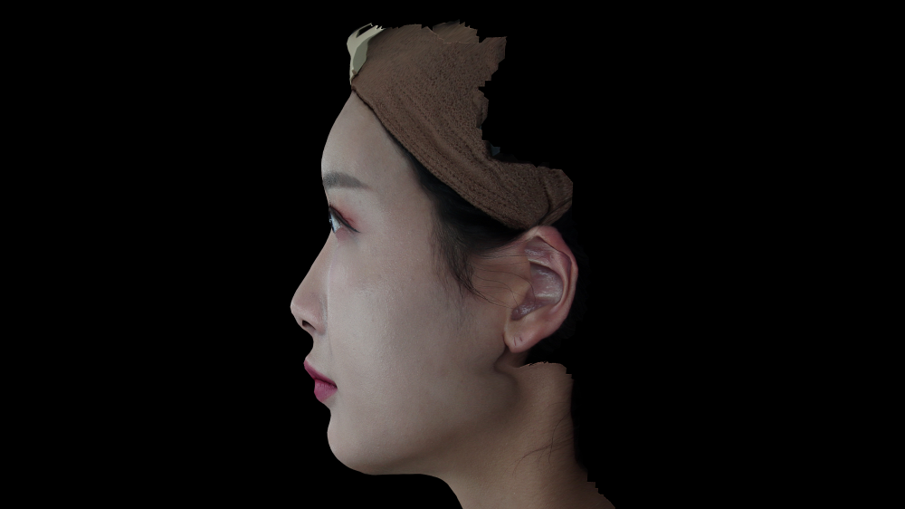 필러 시술 후